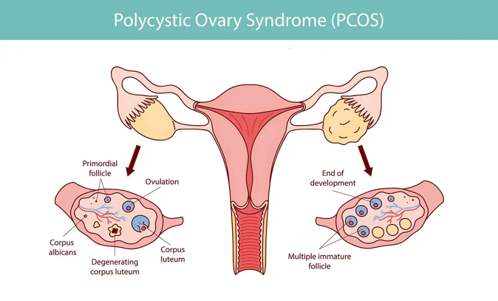 PCOS Treatment in Mulund