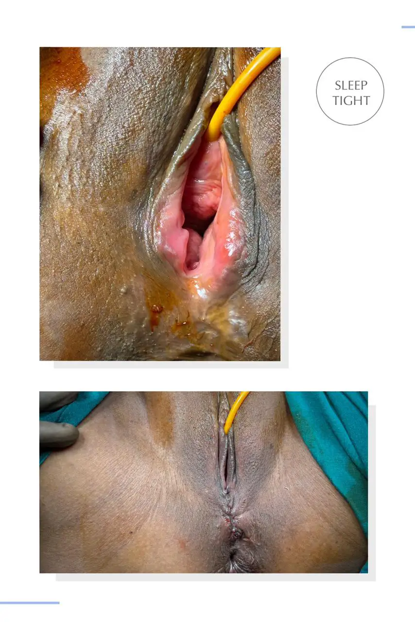 Laser Vaginoplasty in Mulund